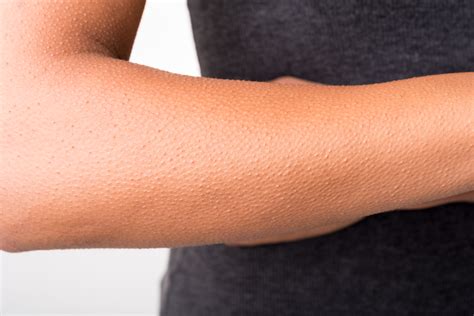 How I Healed Keratosis Pilaris Small Bumps On The Arms The Naked Chemist