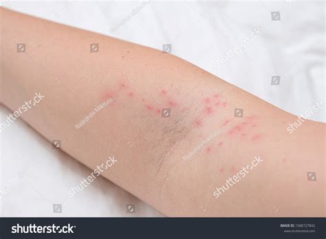 Skin Rash On Female Arm Itchy Foto De Stock Shutterstock