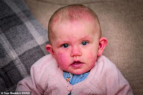 Mother Of Girl Born With Purple Birthmarks Hid Her From Strangers For