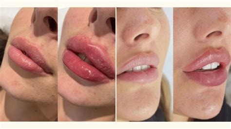 Russian Lip Filler Technique Vs Normal What S The Difference The
