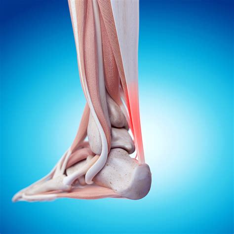 How Runners Heal Achilles Tendinitis Without A Doctor And Keep Running