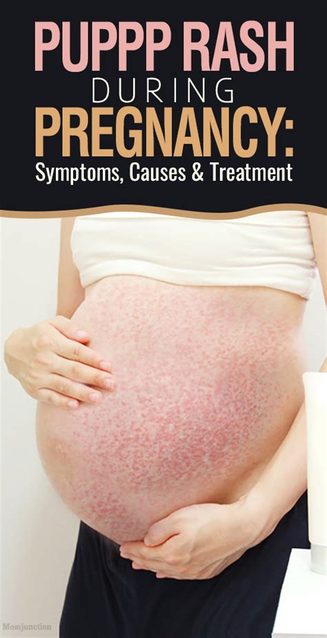 Puppp Rash In Pregnancy Prevention Treatment And Remedies