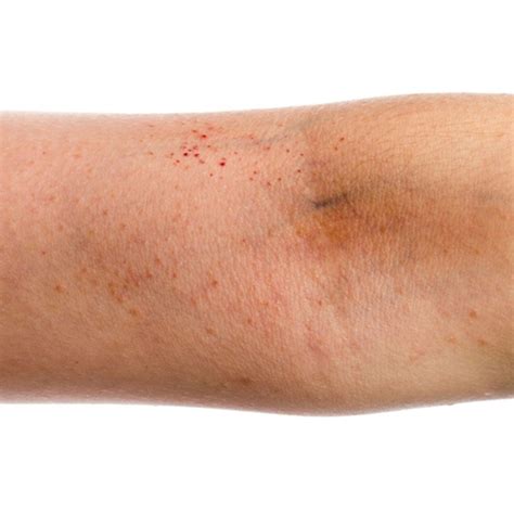 What Drives Treatment Satisfaction Among Adults With Atopic Dermatitis