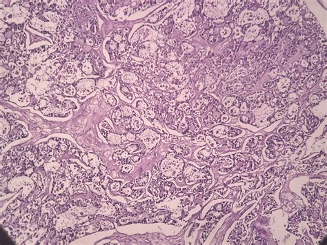 Clear Cell Carcinoma Ovary Histopathologyguru