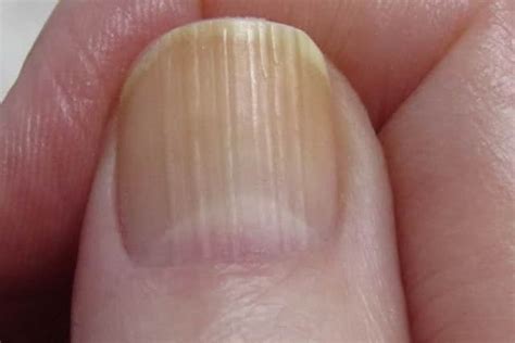 What Do Vertical Ridges On Fingernails Mean Organic O
