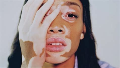 Vitiligo Skin Disease Is A Condition In Which The Skin Loses