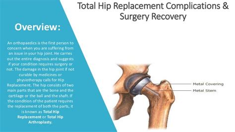 Total Hip Replacement Complications And Surgery Recovery