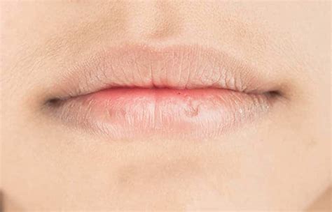 Eczema On Lips Causes Treatment Options And Prevention Tips