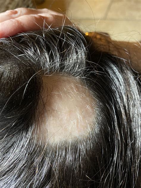 Are Those White Hairs Signs Of Regrowth And If So Will They Ever