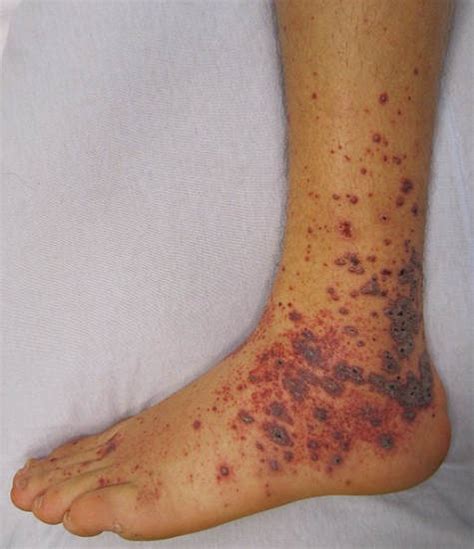 Purple Spots On Skin What You Need To Know Harmless Or Serious