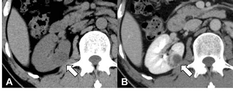 Cureus Radiological Features Of T1a Renal Cell Carcinoma On Axial