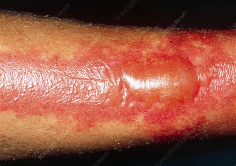 Extensive Second Degree Burns On A Mans Leg Stock Image M3350124