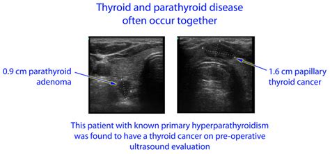 Thyroid And Parathyroid Disease Endocrine Surgery Ucla Health
