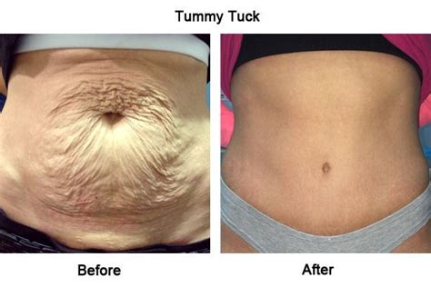 Understanding Tummy Tuck Surgery Abdominoplasty Types Recovery Costs And Risks Tummy Tuck