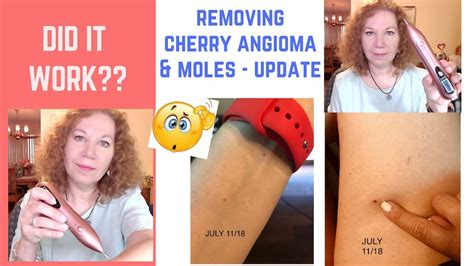Cherry Angioma On Lip Removal Cherry Angioma Removal Total Body