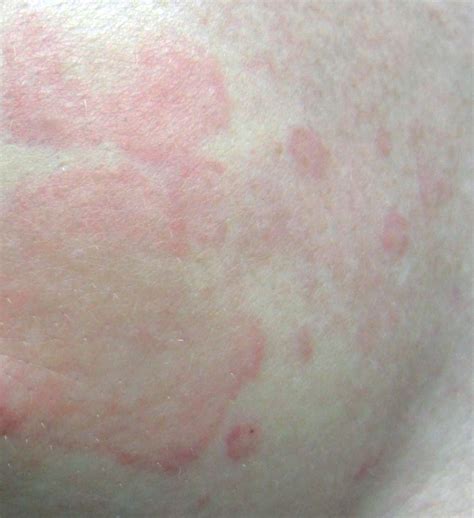 Itchy Skin Cancer Julimessage