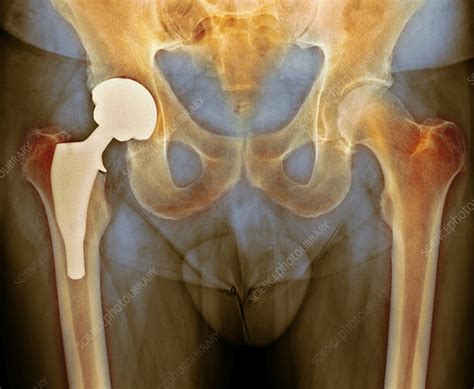 Total Hip Replacement X Ray Stock Image F0121369 Science Photo