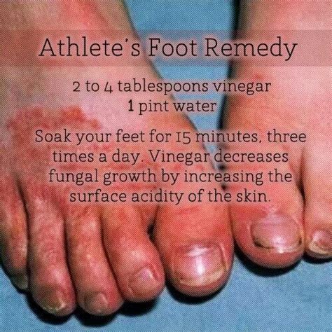Athletes Foot Remedy Foot Remedies Athletes Foot Remedies Athletes Foot