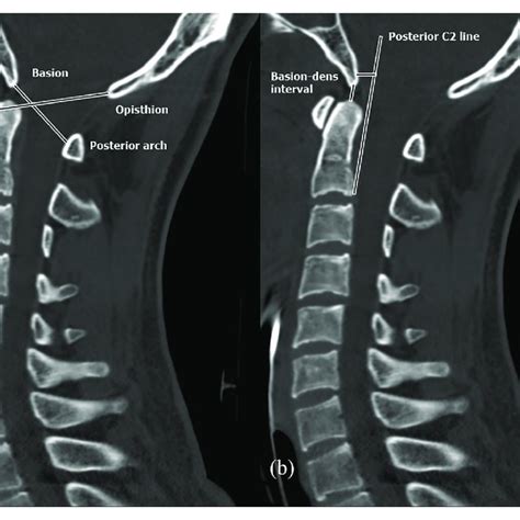 Cervical Spine Ct Scan With Normal Findings A Powers Ratio And B