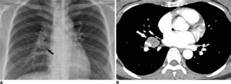 Figure 7typical And Atypical Manifestations Of Intrathoracic