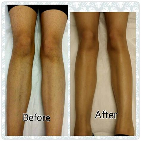 Laser Hair Removal Before And After Legs Kenisha Mccollum