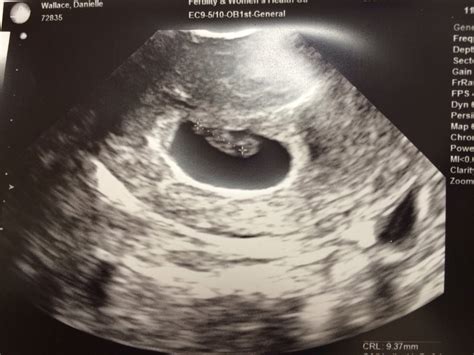 By Gods Grace 7 Weeks Our 1st Ultrasound