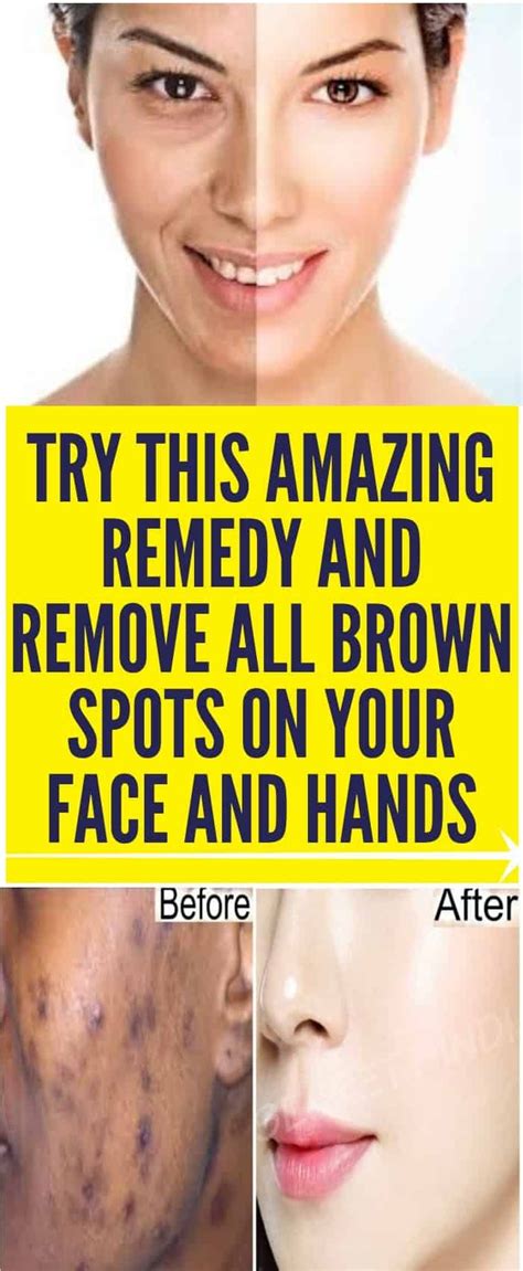 Try This Amazing Remedy And Remove All Brown Spots On Your Face And