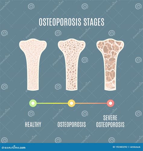 Osteoporosis Enfermedad Por Pérdida De Densidad ósea Infografía Médica
