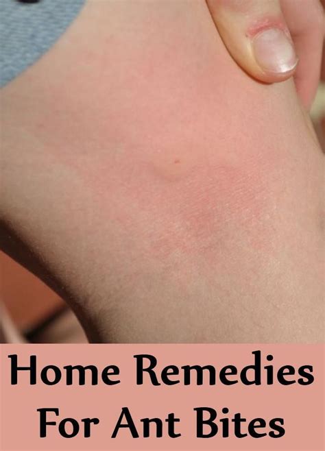 5 Most Effective Home Remedies For Ant Bites Ant Bites Home Remedies