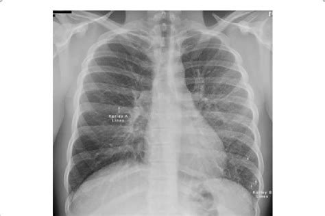 Pulmonary Interstitial Edema X Ray Hot Sex Picture