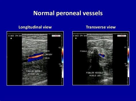 Doppler Ultrasound Of Lower Limb Arteries