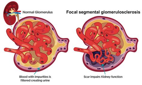 Focal Segmental Glomerulosclerosis Causes Symptoms Diagnosis And Treatment