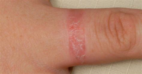 Ring Rash Causes Symptoms And Treatment