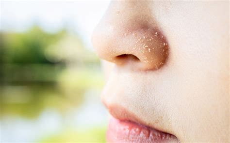 9 Reasons Of Dry Skin Around Nose And How To Treat It Skinkraft