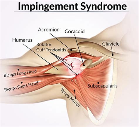 However, more serious injuries, such as complete rotator cuff tears, may require surgical repair. Shoulder Impingement Treatment NYC | Impingement Syndrome