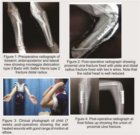 Monteggia Fracture Dislocation With Ipsilateral Distal Radius Ulna