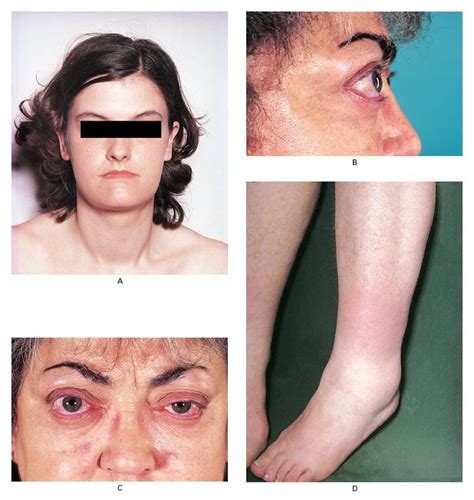 Pictures Of Graves Disease Captions Profile