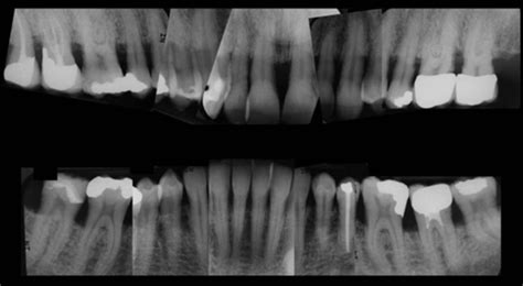 23 Chronic Periodontitis Pocket Dentistry