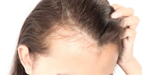 Traction Alopecia Everyday Things You Do That Can Cause Hair Loss