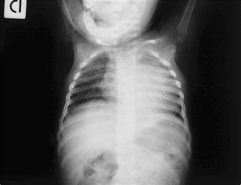 Chest X Ray Showing Widespread Lung Hyperinflation And Severe
