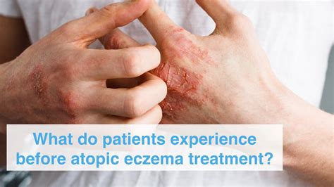 What Do Patients Experience Before Atopic Eczema Treatment By Our