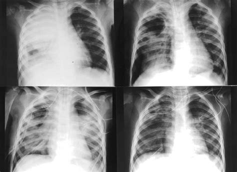 Top Left Cxr On Day 1 Showed Rul Pneumonia And Pleural Effusion Top