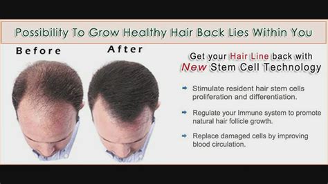 Hair loss leads to different emotions such as embarrassment, frustration, and a complete loss of confidence. Hair Loss Cure Exosomes | Hair Loss