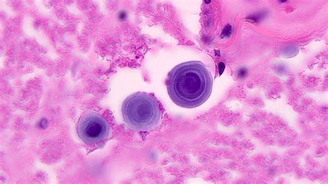 Pathology Outlines Cryptococcus Neoformans And Gattii