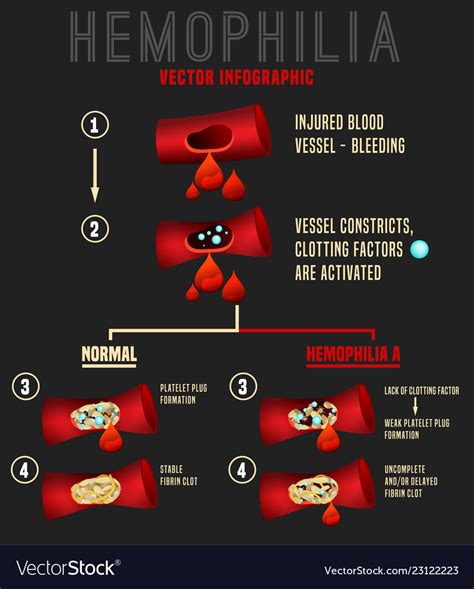 Hemophilia Infographics Image Royalty Free Vector Image