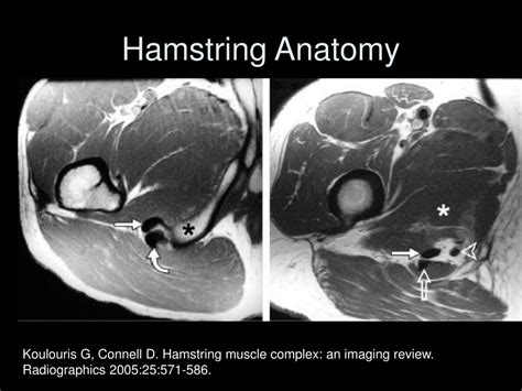 PPT Current Concepts In Magnetic Resonance Imaging Of The Hip