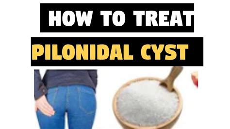 How To Treat Pilonidal Cyst Successful Home Treatments Top 5 Home Remedies For Pilonidal Cysts