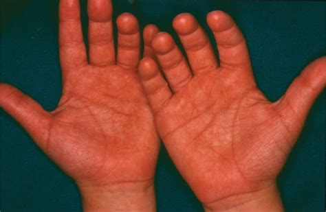 Hand Swelling Visual Diagnosis And Treatment In Pediatrics 3 Ed