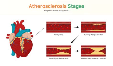 Atherosclerosis The Foundation To Advance Vascular Cures