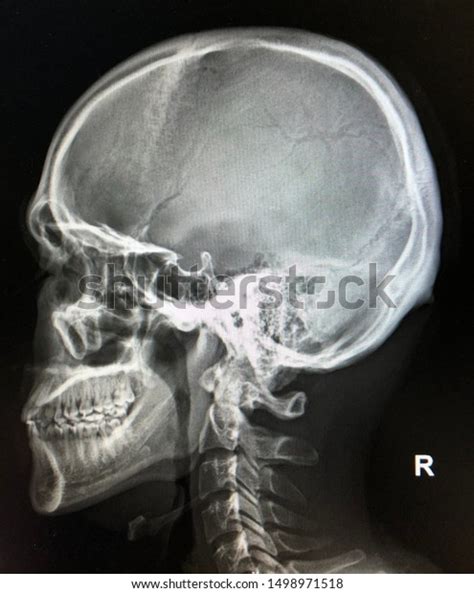 Normal Film Xray Skull Lateral View Stock Photo Edit Now 1498971518